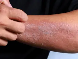 Uzmanı uyardı: Ciltteki kaşıntı ve kuruluk, hastalıkların birinci sinyali olabilir