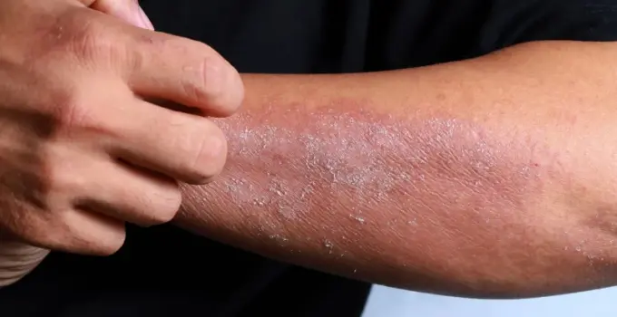 Uzmanı uyardı: Ciltteki kaşıntı ve kuruluk, hastalıkların birinci sinyali olabilir